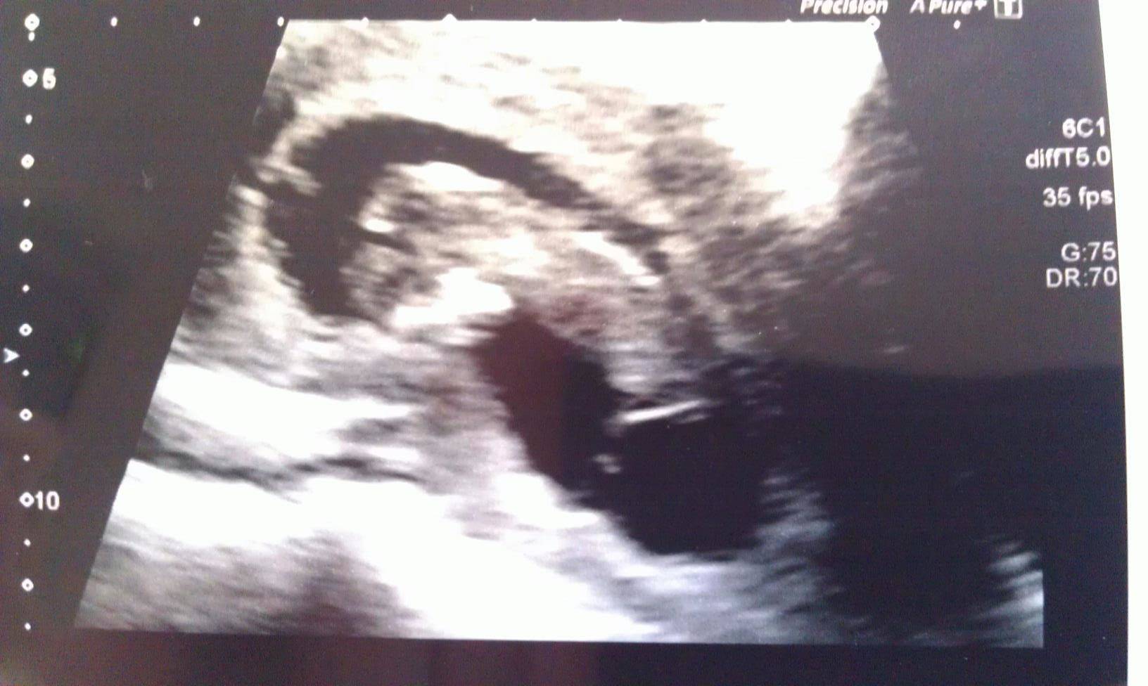 MentaL - Publicly announcing that I'm having my first baby :) - RaGEZONE Forums